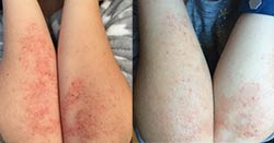 Eczema Improved Tremendously Within 1 Week
