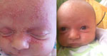 Baby eczema better in 3 days