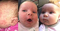 Cradle Cap Dramatically Improved in 4 Days with Emily