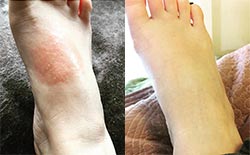 Itchy, Red Rash on Foot Better in 24 Hours with HOT Skin Soother