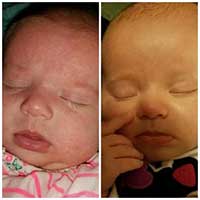 Awful Baby Acne Cleared in 1 Week with Diaper Plus