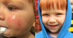 Red Cheeks from Asthma and Eczema Gone with Emily Products